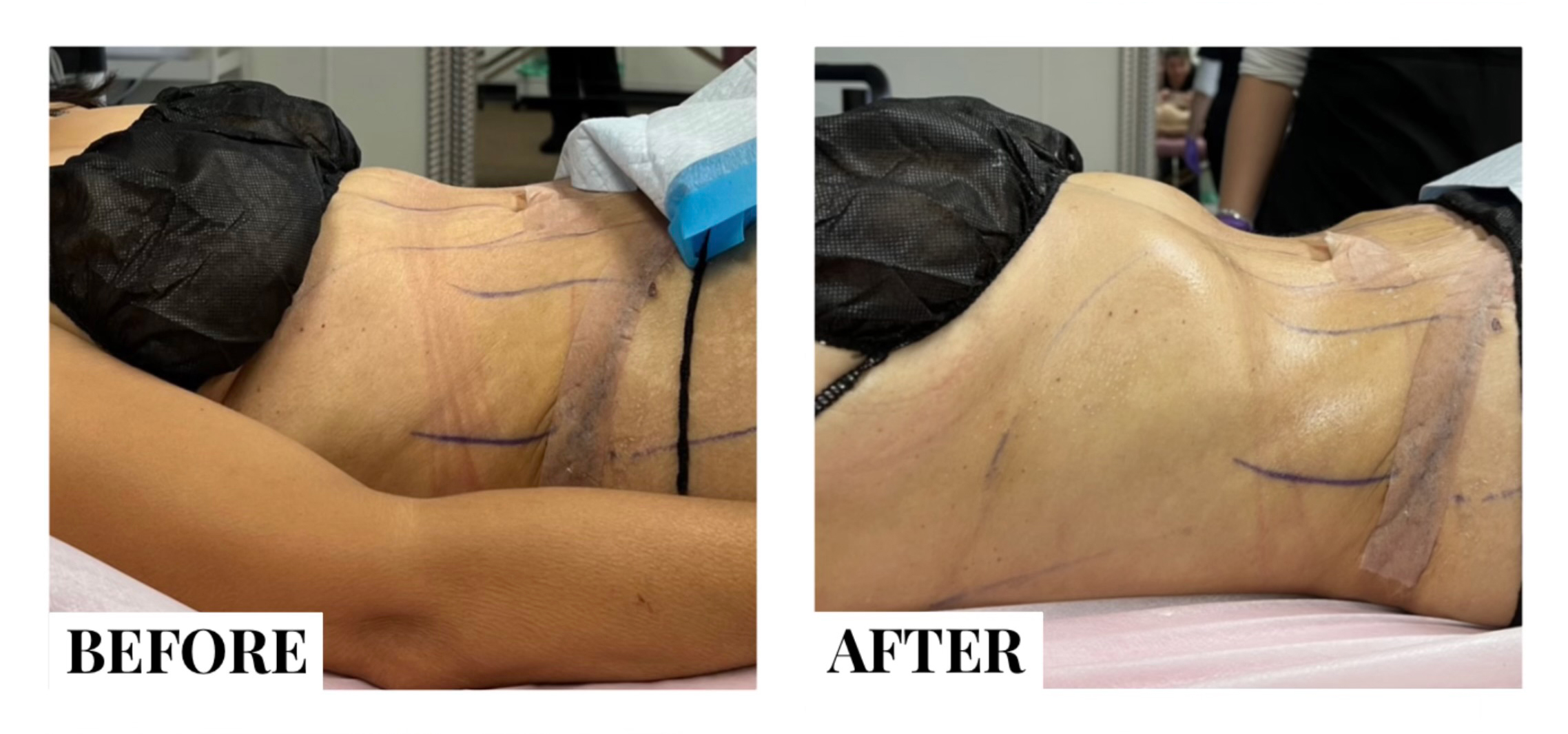 Lymphatic Massage Before and After