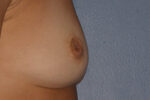 Inverted Nipple Repair