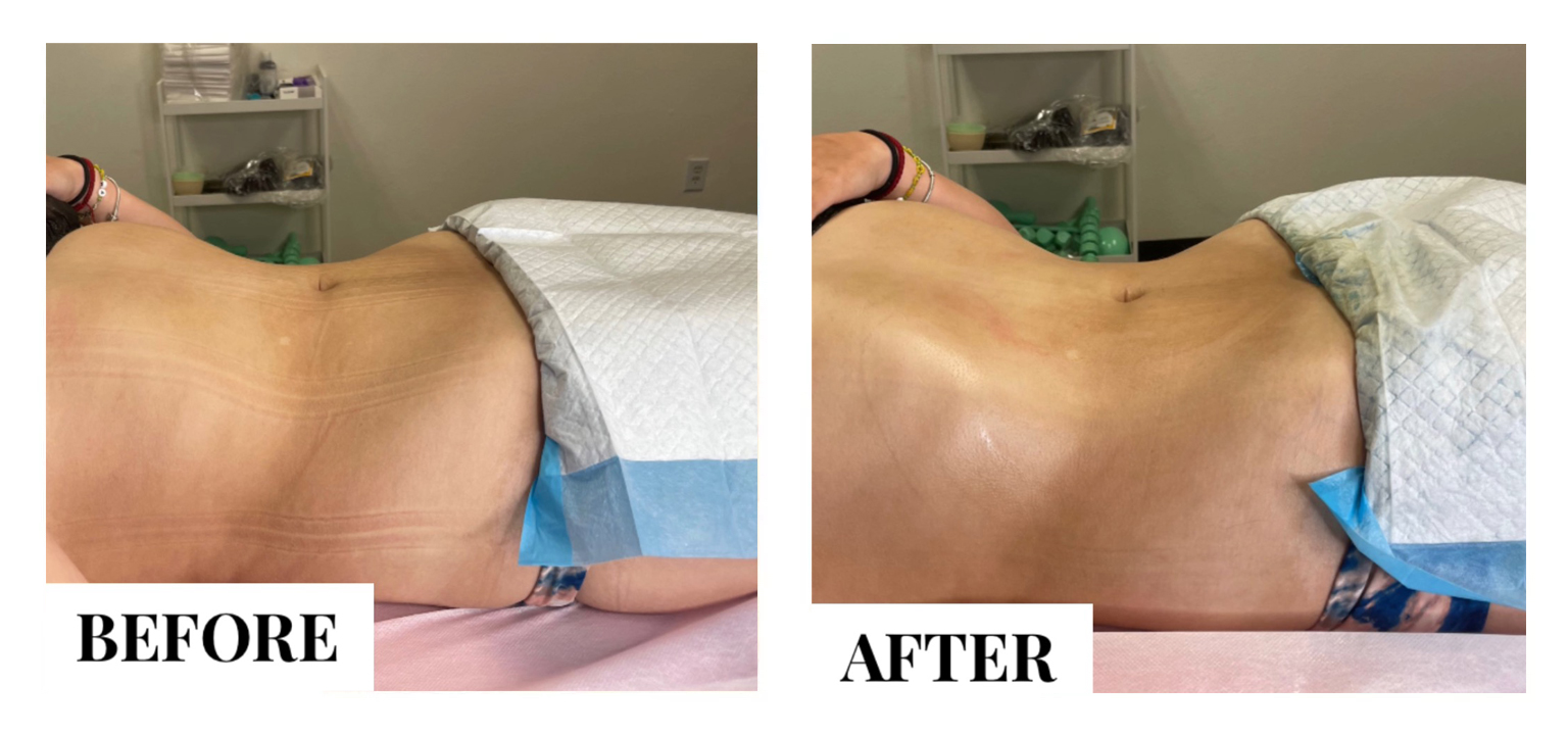 Lymphatic Massage Before and After