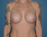 Breast Augmentation by Implant Bellevue