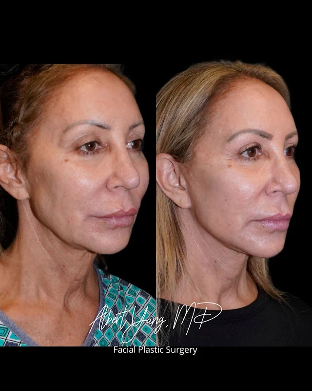 Deep Plane Facelift Before and After Photo by Dr. Parikh in Seattle and Bellevue