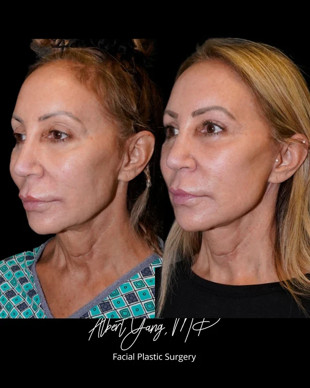 Deep Plane Facelift Before and After Photo by Dr. Parikh in Seattle and Bellevue