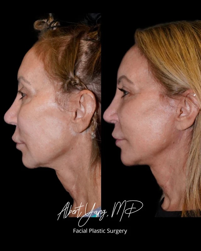 Deep Plane Facelift Before and After Photo by Dr. Parikh in Seattle and Bellevue