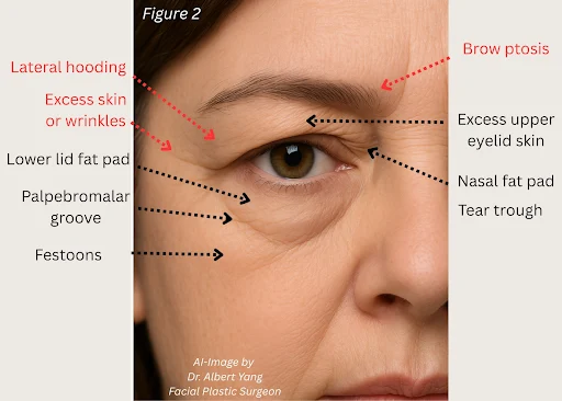 Close-up of an eye area with labels for brow ptosis, lateral hooding, wrinkles, and fat pads.